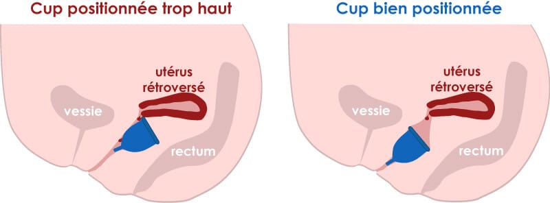 mauvaise position de la cup avec un utérus rétroversé