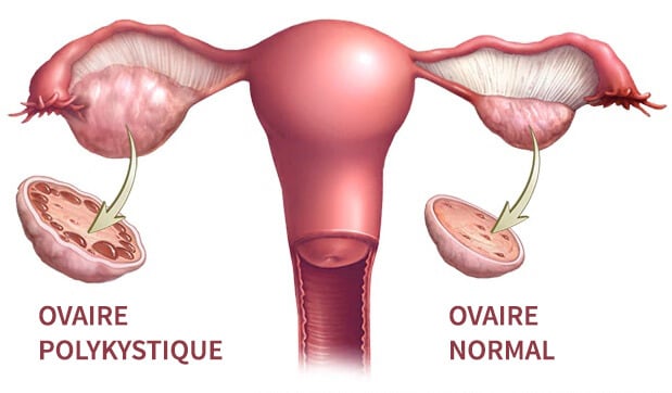 schéma du syndrome des ovaires polykystiques